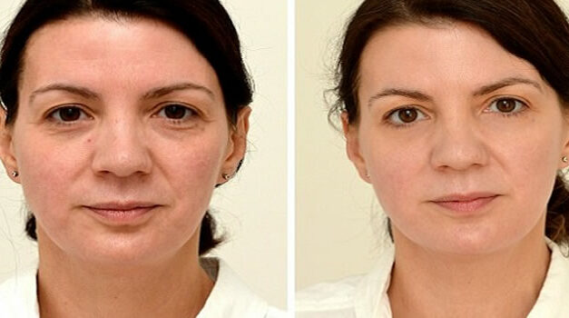 Water drinken verjongt (zie het verschil na vier weken)