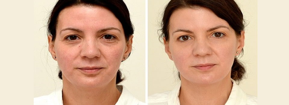 Water drinken verjongt (zie het verschil na vier weken)